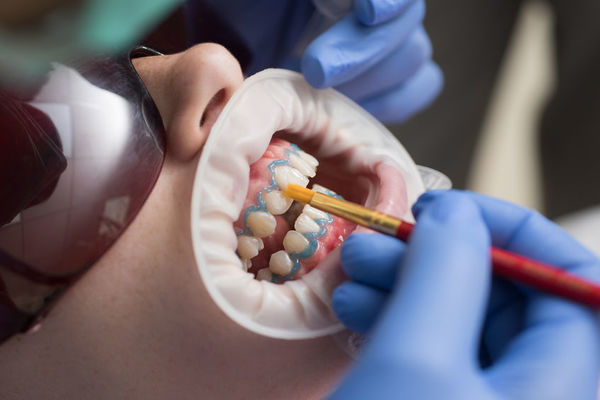 Bielenie zubov - Petriv Clinic | Nová zubná klinika v Žiline